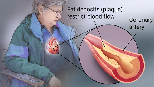 Coronary Artery Disease